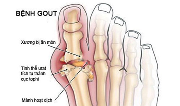 Phương pháp vật lý trị liệu, hỗ trợ chữa bệnh gout không cần dùng thuốc 1