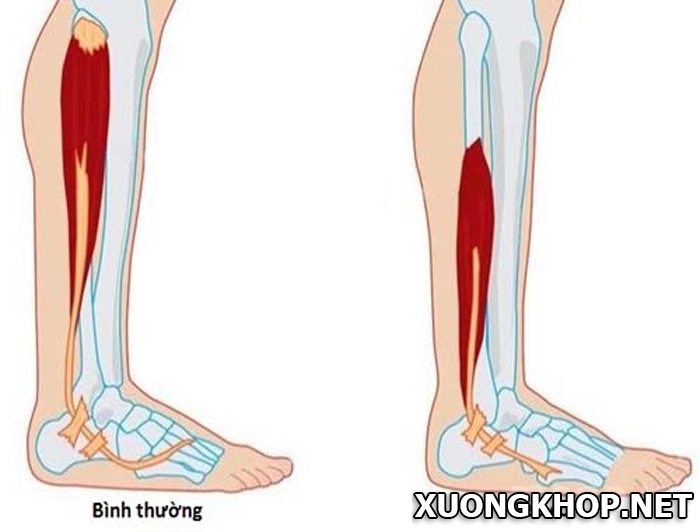 Nguyên nhân gây đau lưng bên trái gần mông và cách điều trị 2