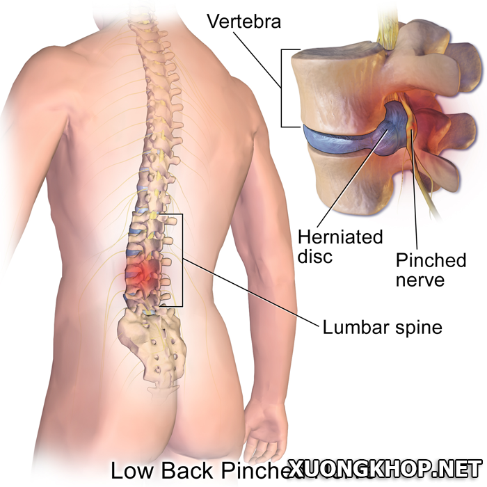 Thoát vị đĩa đệm cột sống thắt lưng là gì? Nguyên nhân và triệu chứng gây ra bệnh thoát vị đĩa đệm cột sống thắt lưng là do đâu? 2