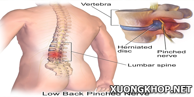 Thoát vị đĩa đệm cột sống thắt lưng là gì? Nguyên nhân và triệu chứng gây ra bệnh thoát vị đĩa đệm cột sống thắt lưng là do đâu?
