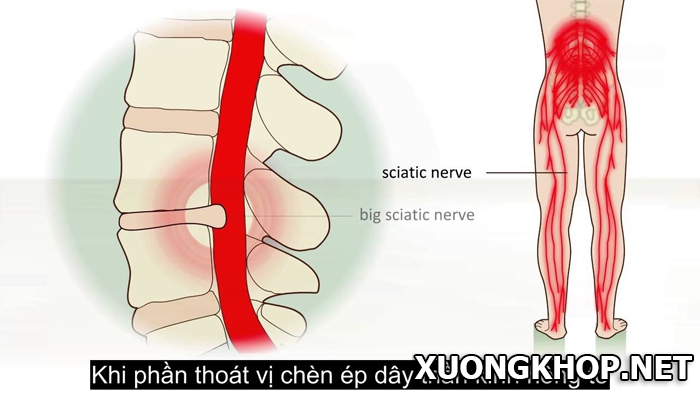 Nguyên nhân gây đau lưng bên trái gần mông và cách điều trị 1