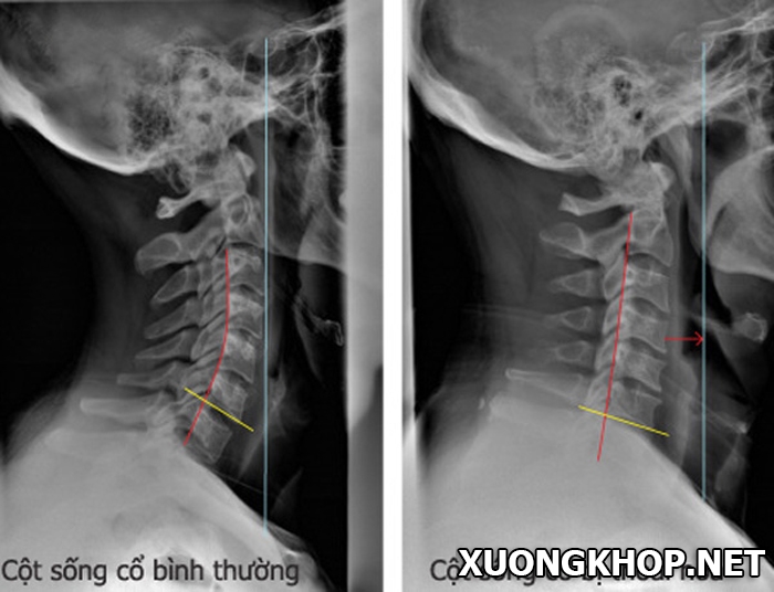 Hình ảnh X quang thoái hóa cột sống 1
