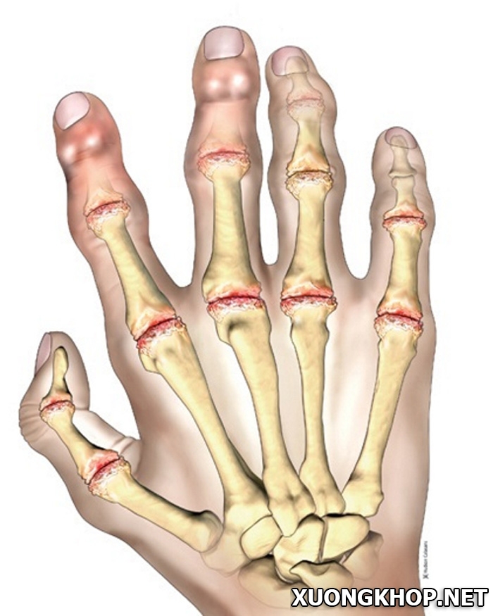 Thoái hóa khớp ngón tay, những dấu hiệu cơ bản nhận biết bệnh 1