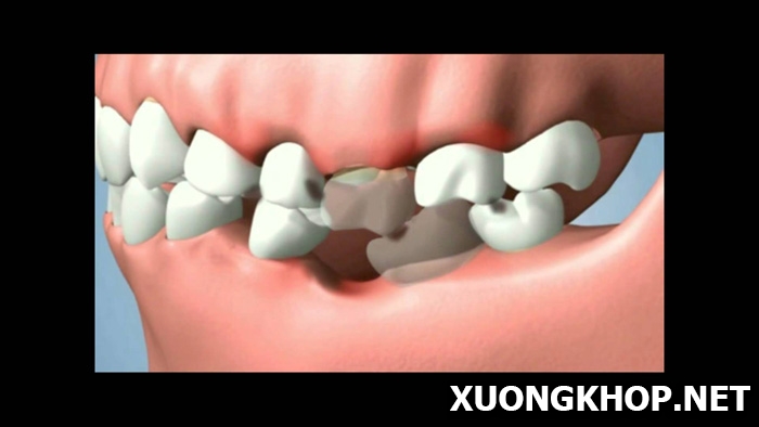 Thoái hóa khớp xương hàm do mất răng và tác hại của bệnh 1