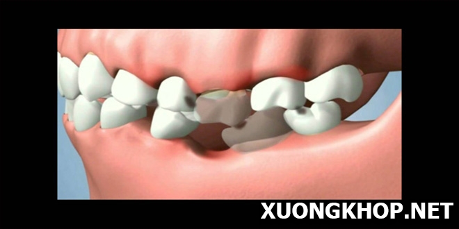 Thoái hóa khớp xương hàm do mất răng và tác hại của bệnh