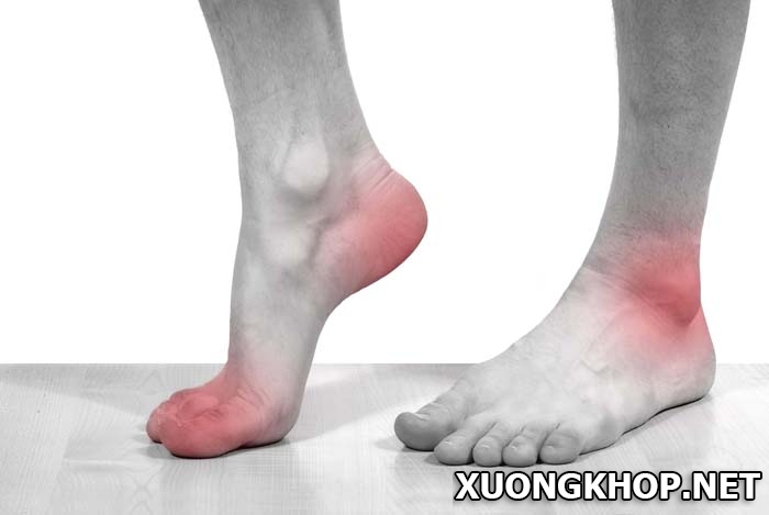 Tìm hiểu dấu hiệu và cách điều trị thoái hóa khớp gót chân 1
