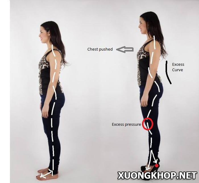 60% nữ giới bị thoái hóa cột sống lưng vì sao? 1