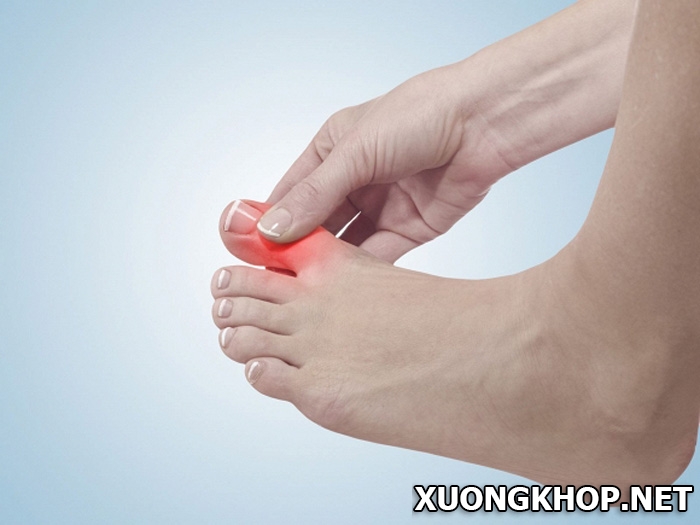 Dấu hiệu của bệnh viêm khớp ngón chân và cách điều trị bệnh hiệu quả 1