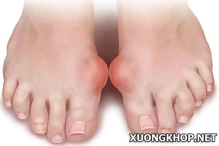Hỏi đáp: Viêm khớp bàn ngón chân là bệnh gì và cách điều trị bệnh hiệu quả 1