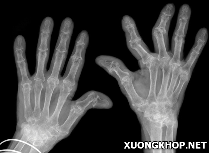 4 nguyên nhân hàng đầu dẫn đến bệnh thoái hóa khớp ngón tay giữa 2