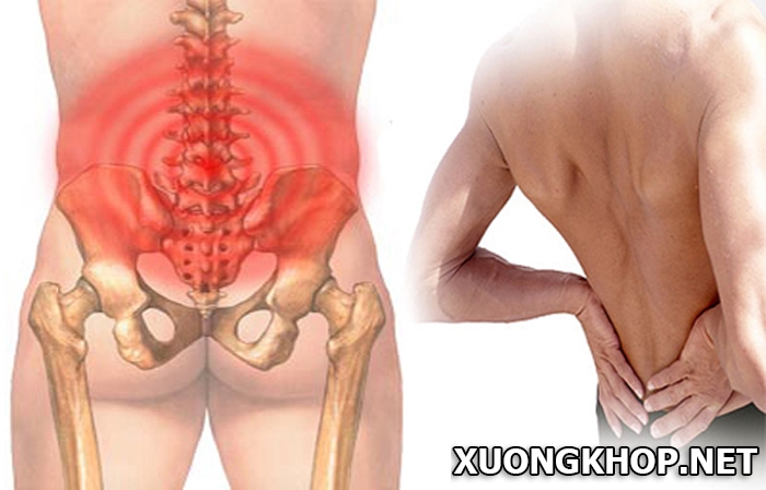 Đau lưng đau hông nguyên nhân là do đâu? Triệu chứng bệnh như thế nào? 1