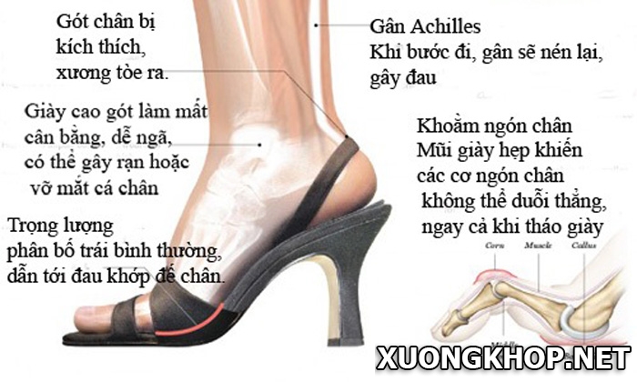 Giày cao gót - Thủ phạm gây đau gai cột sống ở phụ nữ 1