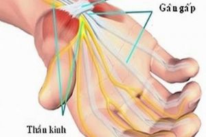 Hội chứng đường hầm cổ tay là gì và cách điều trị như thế nào