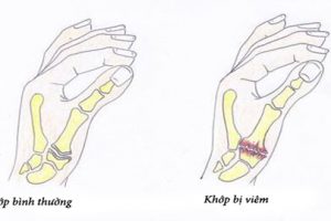 Viêm khớp bàn ngón tay là gì? Triệu chứng và phương pháp phòng bệnh
