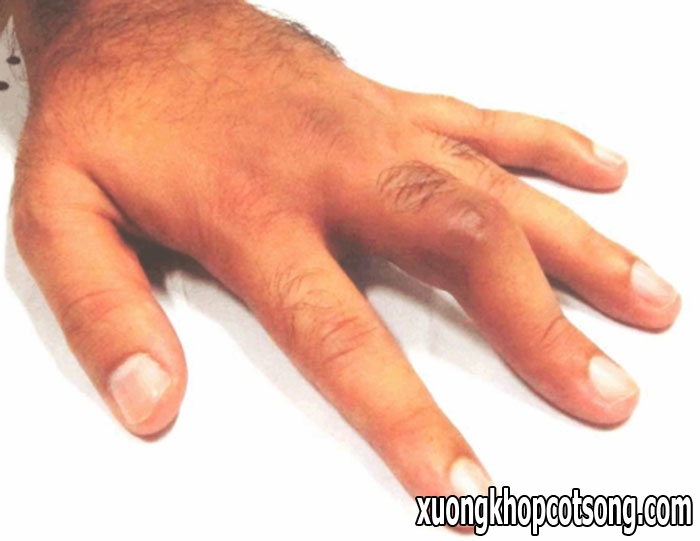 Viêm khớp ngón tay giữa và những biến chứng khó lường 2